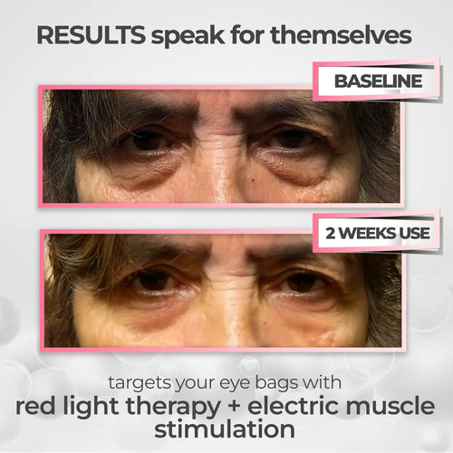Revive™ – Red Light Therapy for Dark Circles & Puffiness
